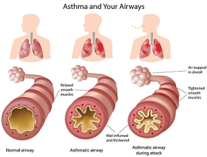 asthma1