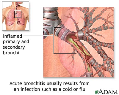 bronchitis1