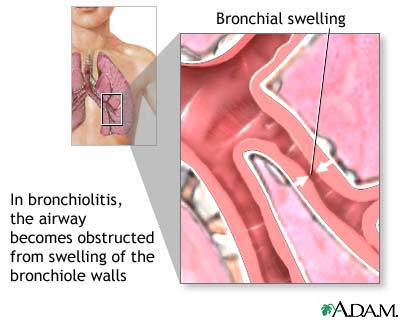 bronchitis2