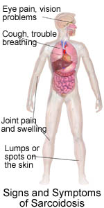sarcoid